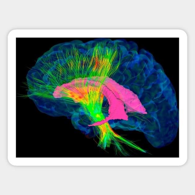 Brain fibres, DTI MRI scan (C017/7036) Sticker by SciencePhoto